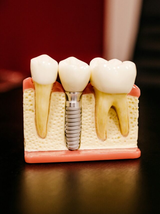 What is the single tooth implant cost without insurance?